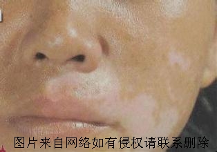 电脑辐射会影响白癜风患者病情么