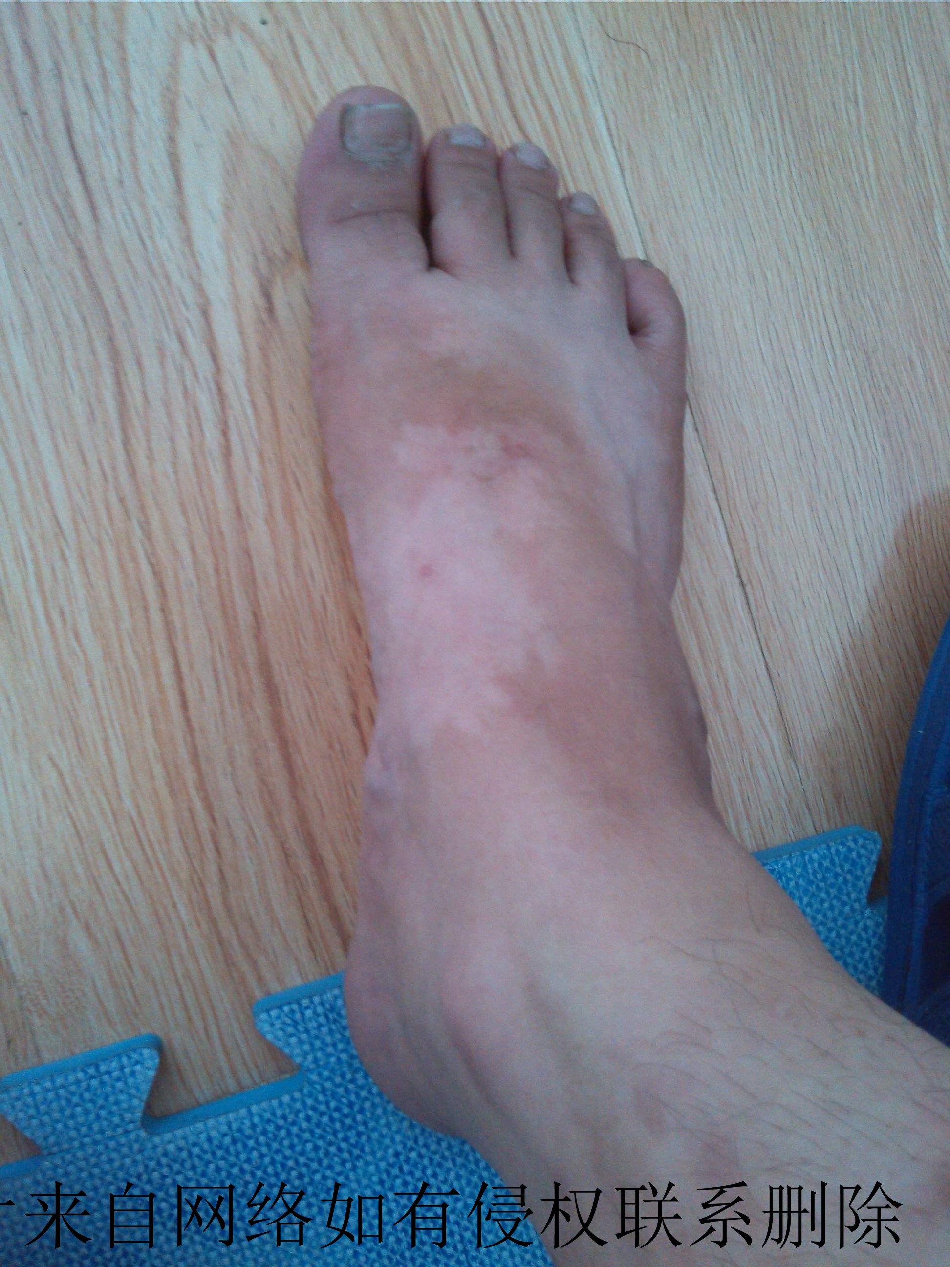 白癜风要怎么有效的预防