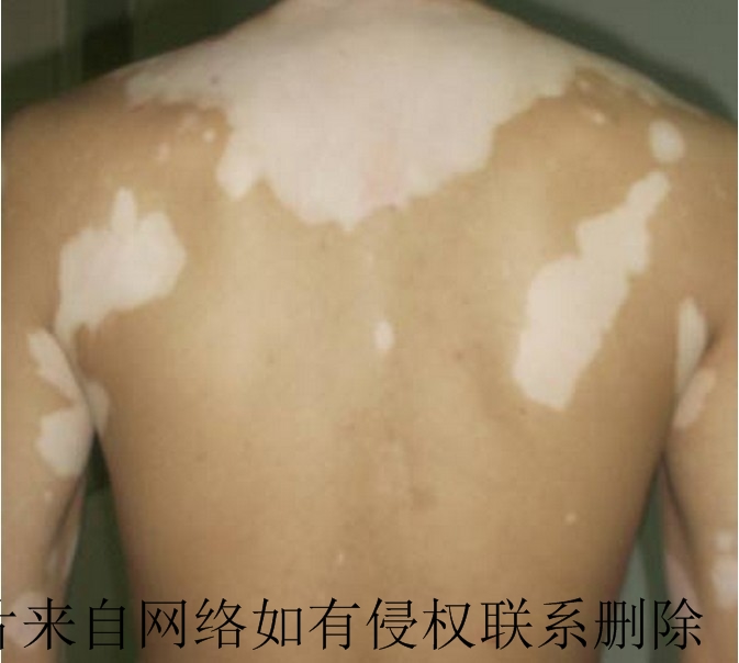 白癜风患者要怎么进行日常护理