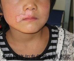 白癜风患者饮食上要注意哪些