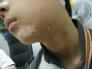 白癜风图片 白癜风图片