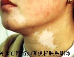 白癜风要如何科学诊治