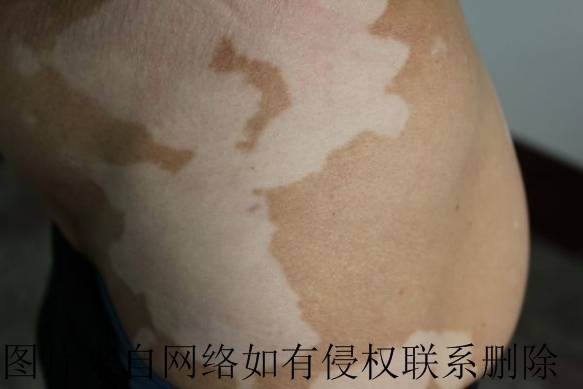 孕妇白癜风如何调理与治疗