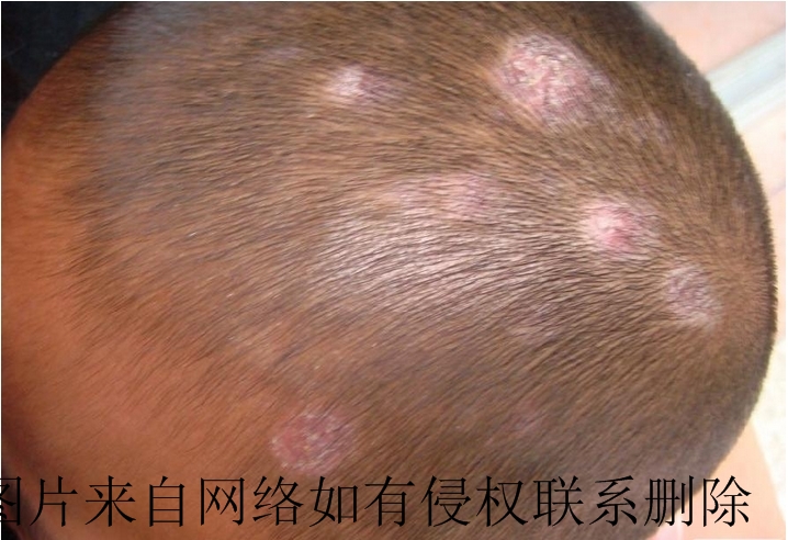 儿童白癜风怎么医治才更好