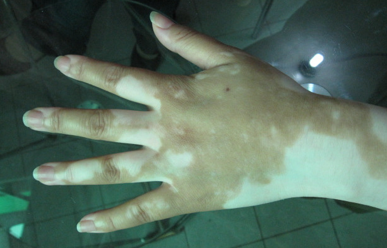 怎么通过白斑观察是不是患了白癜风呢?.jpg