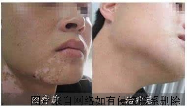 白癜风患者能够吃羊肉吗