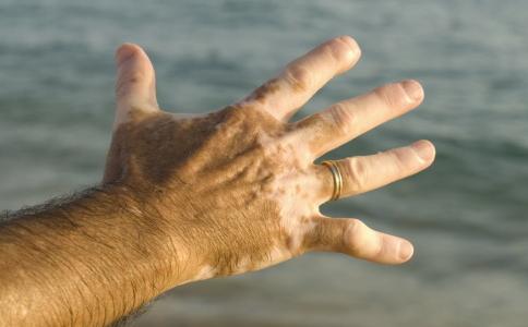 白癜风图片 白癜风图片