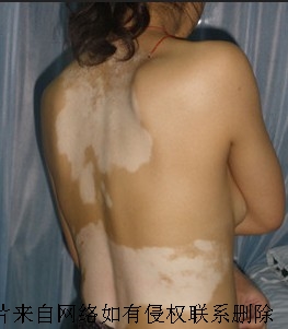 女性白癜风会发生遗传么