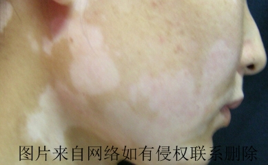 白癜风患者要关注哪些治疗重点