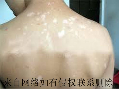 白癜风危害极大,不可忽视