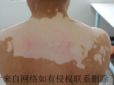 白癜风会引发哪些并发症