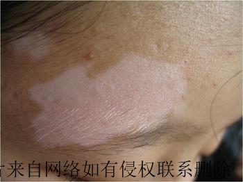 白癜风治疗需要哪些科学护理