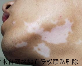 面部白癜风患者要注意哪些
