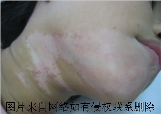 脖子上白癜风治疗中注意哪些