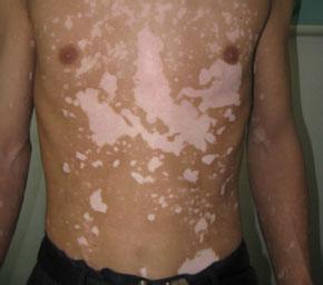 白癜风图片 白癜风图片