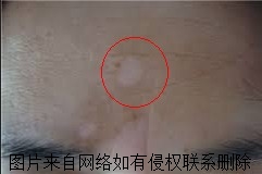 白癜风预防它发病怎么做