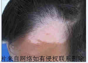 脸部白癜风发病有何特点