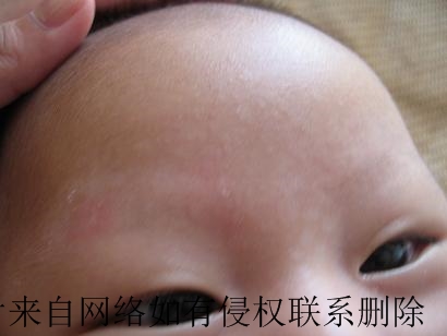 白癜风好转有什么症状