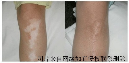 手臂白癜风要怎么进行治疗