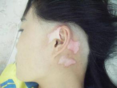 颈部白癜风症状.jpg