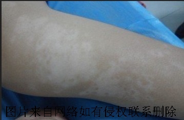 白癜风患者治疗中禁忌什么