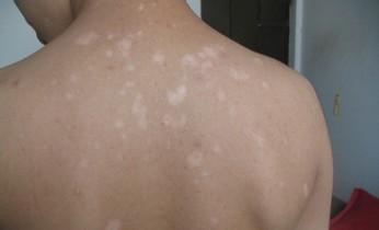 早期白癜风怎样治疗