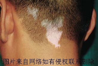 头部出现白癜风洗发注意哪些