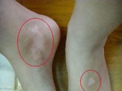 正确治疗白癜风的方法有哪些?