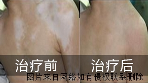 白癜风会带来哪些严重危害