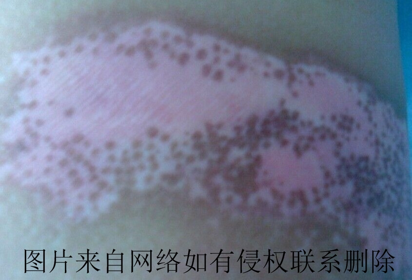 白癜风偏方治疗注意哪些事项