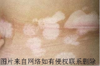 老年白癜风要怎么治疗