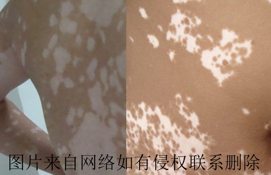 白癜风常要进行的护理措施有哪些