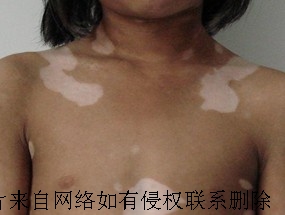 导致白癜风恶化的原因有哪些