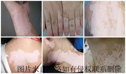 白癜风要怎么预防才好